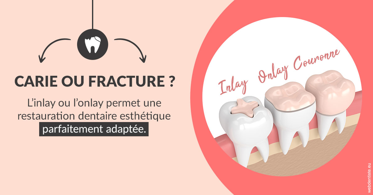 https://www.abcd-dentiste.fr/T2 2023 - Carie ou fracture 2
