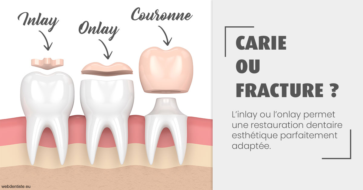 https://www.abcd-dentiste.fr/T2 2023 - Carie ou fracture 1