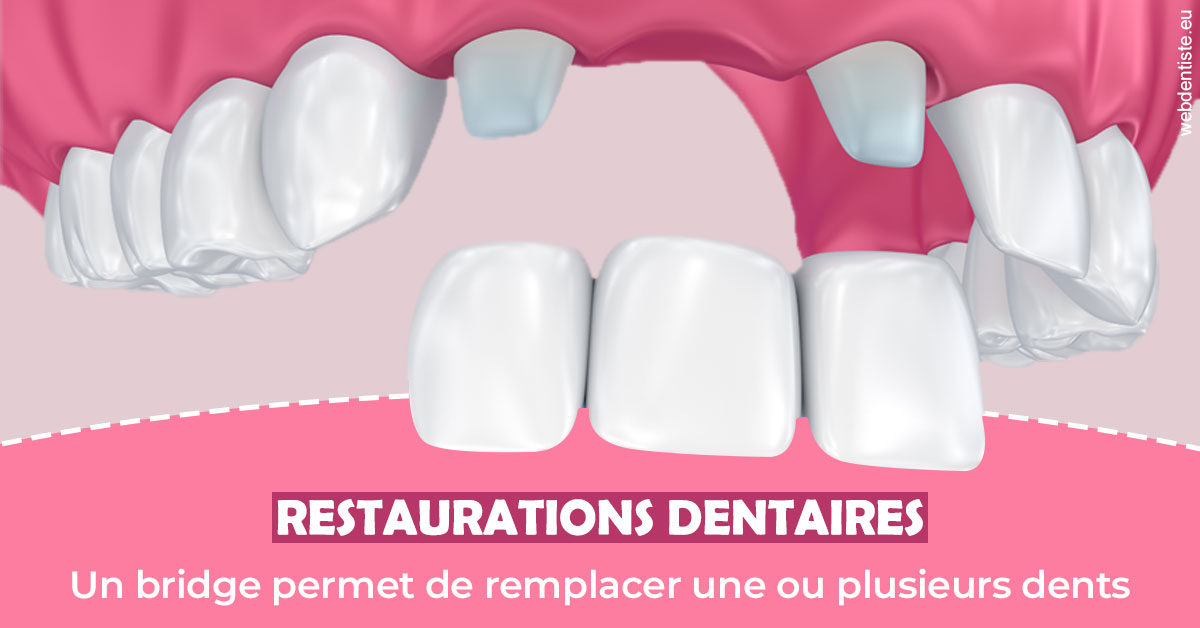 https://www.abcd-dentiste.fr/Bridge remplacer dents 2