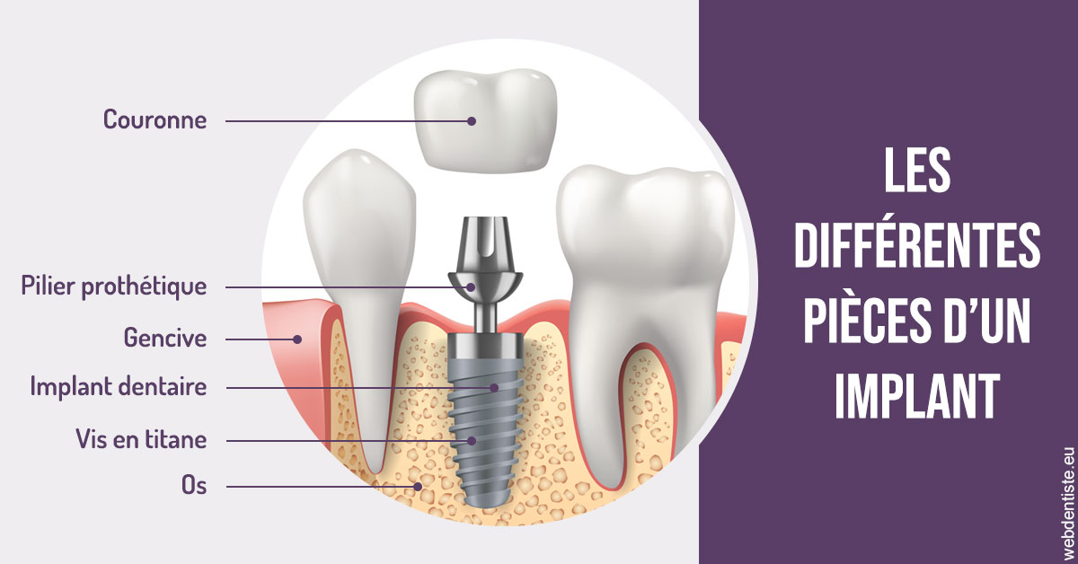 https://www.abcd-dentiste.fr/Les différentes pièces d’un implant 2