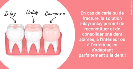 https://www.abcd-dentiste.fr/L'INLAY ou l'ONLAY 2