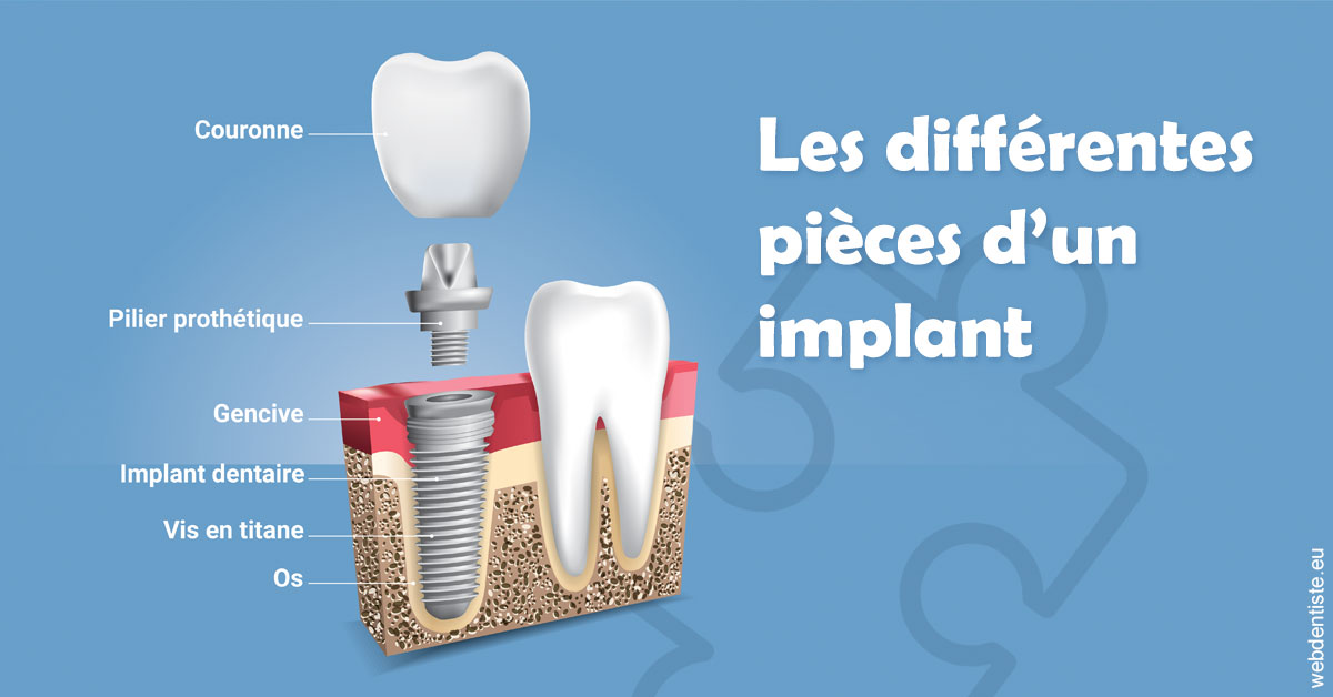 https://www.abcd-dentiste.fr/Les différentes pièces d’un implant 1