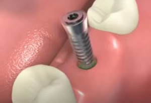 Couronne sur implant dentaire